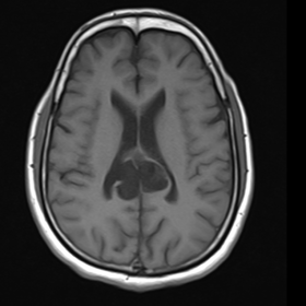 MRI Brain T1 Axial