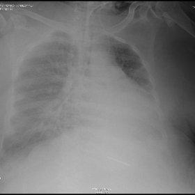 Right Sided Bochdalek Hernia Plain Chest X Rays