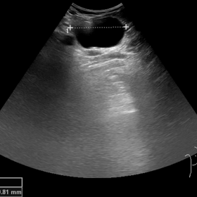 Ultrasound grayscale examination of the neck