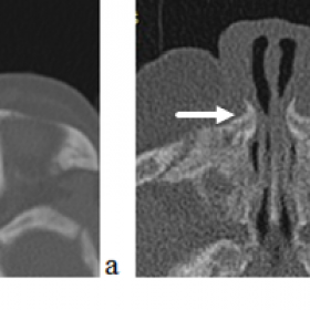 CT scan at the level of the maxillary bone