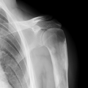 Radiograph of the left shoulder