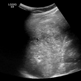 Figure 1-Longitudinal gray-scale and color Doppler sonograms of the spleen
