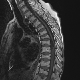 Spinal arachnoid cyst secondary to meningeal metastasis