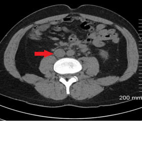 Abnormal IVC anatomy on triple phase renal CT