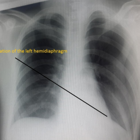 Chest X-ray showing an elevation of the left hemidiaphragm