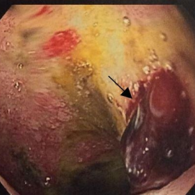 Diffuse necrotic ulcers at the duodenal bulb.
