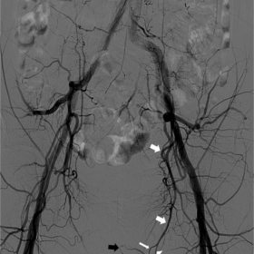 Consecutive frames from a distal aortic digital subtraction angiogram (DSA)