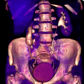 CT with 3-D reconstruction abdomen and pelvis
