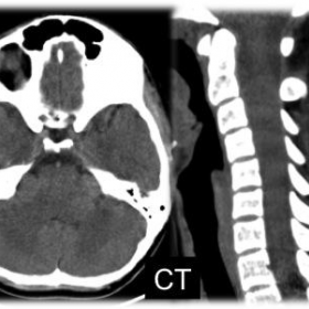 Brain and cervical spine CT
