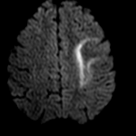 Axial diffusion-weighted image and ADC map of the brain