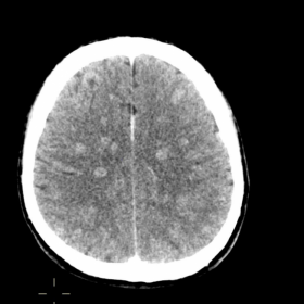 Axial Contrast Enhanced CT Brain