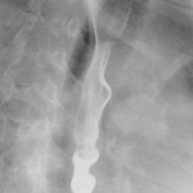 Double-contrast upper gastrointestinal (GI) radiographic study