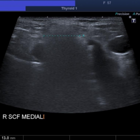 Ultrasound supraclavicular region