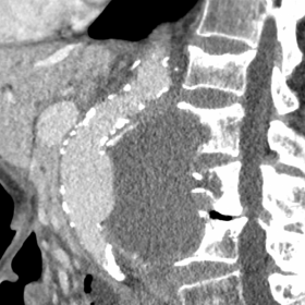 Contained aortic rupture with vertebral erosion.