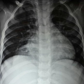 Chest X-ray PA view