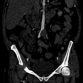 Coronal CTA abdomen and pelvis