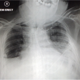 Chest radiograph demonstrating CVL within the left hemi-thorax