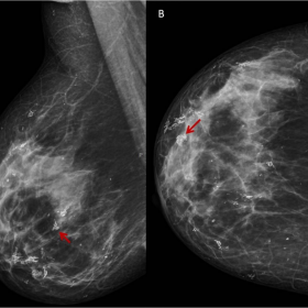 Breast mamography