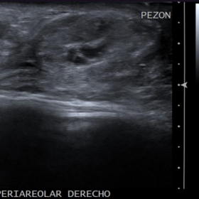 Righ breast ultrasound
