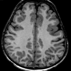 MRI Brain MPRAGE Image