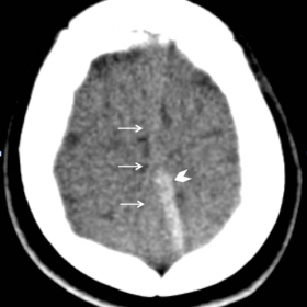 Unenhanced CT of the brain