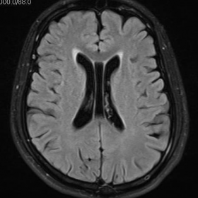 FLAIR Axial MRI