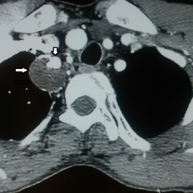 Volumetric CT angiogram