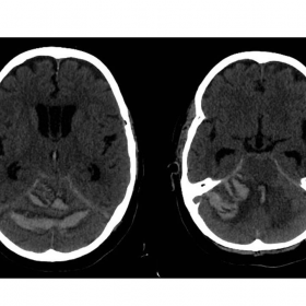 A brain CT without contrast, axial section.