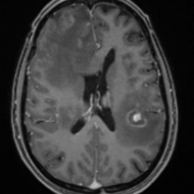 T1 C+ MRI Axial sections of Brain