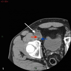 Acetabular paralabral cyst (white arrow) seen compressing the right CFA