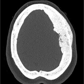 Axial and sagittal CT with bone window