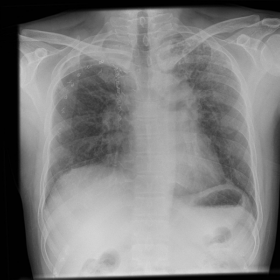 Interval chest X-ray