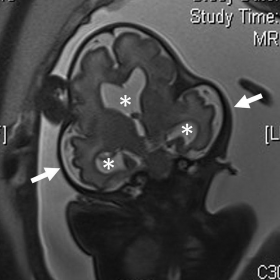 Magnetic resonance imaging of the fetal head