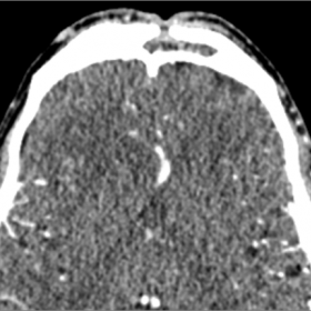 Axial CT of the paranasal sinuses on a brain window