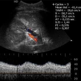 Doppler ultrasound of renal arteries