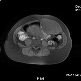 The transverse T-weighted MR image