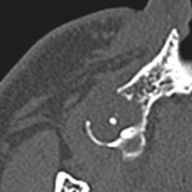 Axial CT imag of the paranasal sinuses
