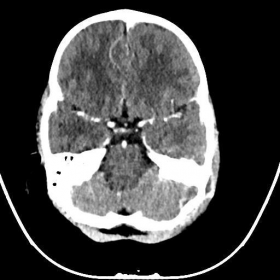 Axial post-contrast CT