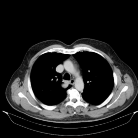 Chest CT axial