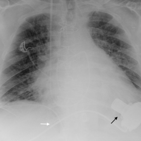 Plain AP thorax radiography