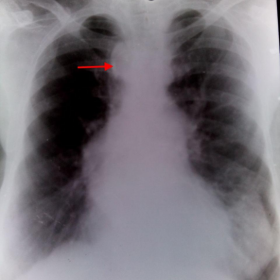 Chest radiograph PA view