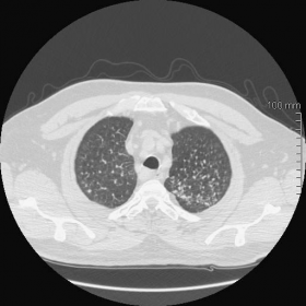 Chest CT lung window