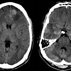 Axial unenhanced (a) and enhanced (b) brain CT