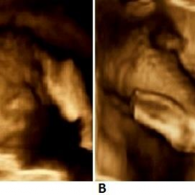 Fetal 3D ultrasound image