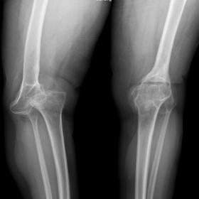 Frontal standing radiographs of both knee joints