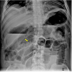Direct abdominal X-ray