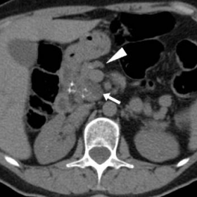 Unenhanced and portal venous phase post-contrast multidetector CT
