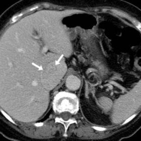 Contrast-enhanced multidetector CT for follow-up of resected renal carcinoma