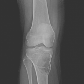 Radiograph of right knee (AP & lateral views)
