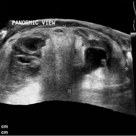 Ultrasound panoramic view of left renal lesion